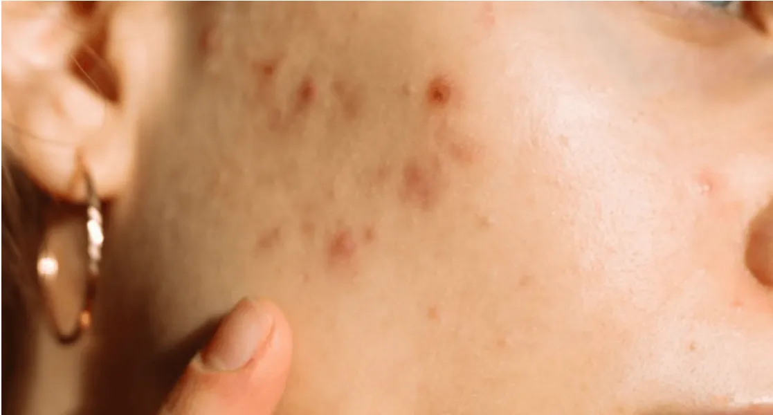 Acné " connaitre l'essentiel"